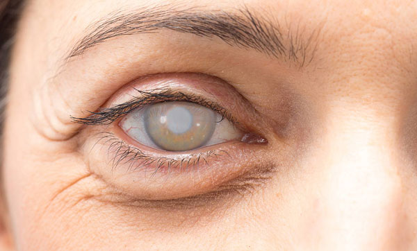 cataract1.jpg