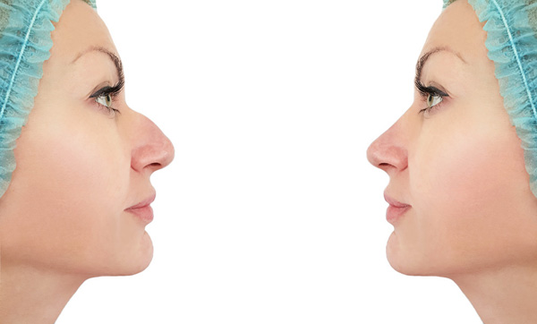 rhinoplasty12.jpg