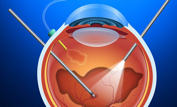 vitrectomy1-min1.jpg